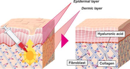 The effects last for a long time because your skin is regenerated!