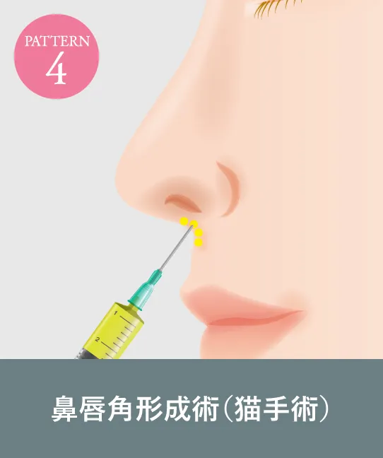 鼻唇角形成術（猫手術）