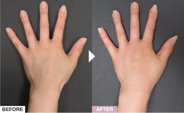 ハンドスクレロセラピーの症例写真