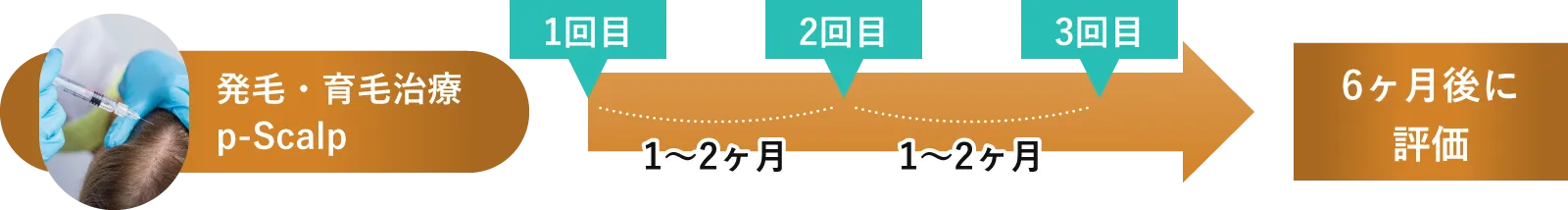 ピー・スカルプ治療スケジュール例：モデルプラン