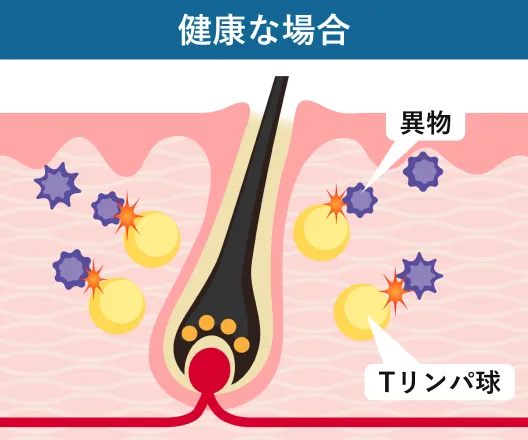 自己免疫反応はなぜ起きる？