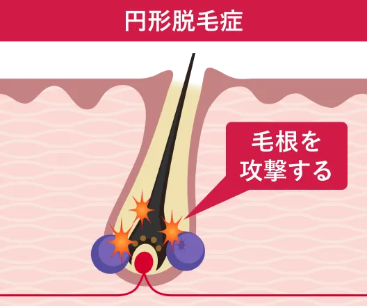 自己免疫反応はなぜ起きる？