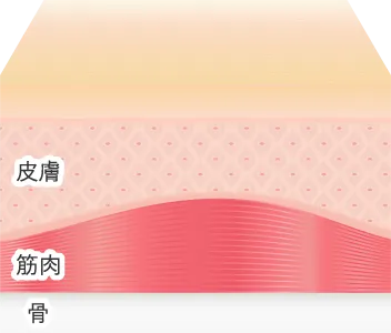 PRP注射による治療