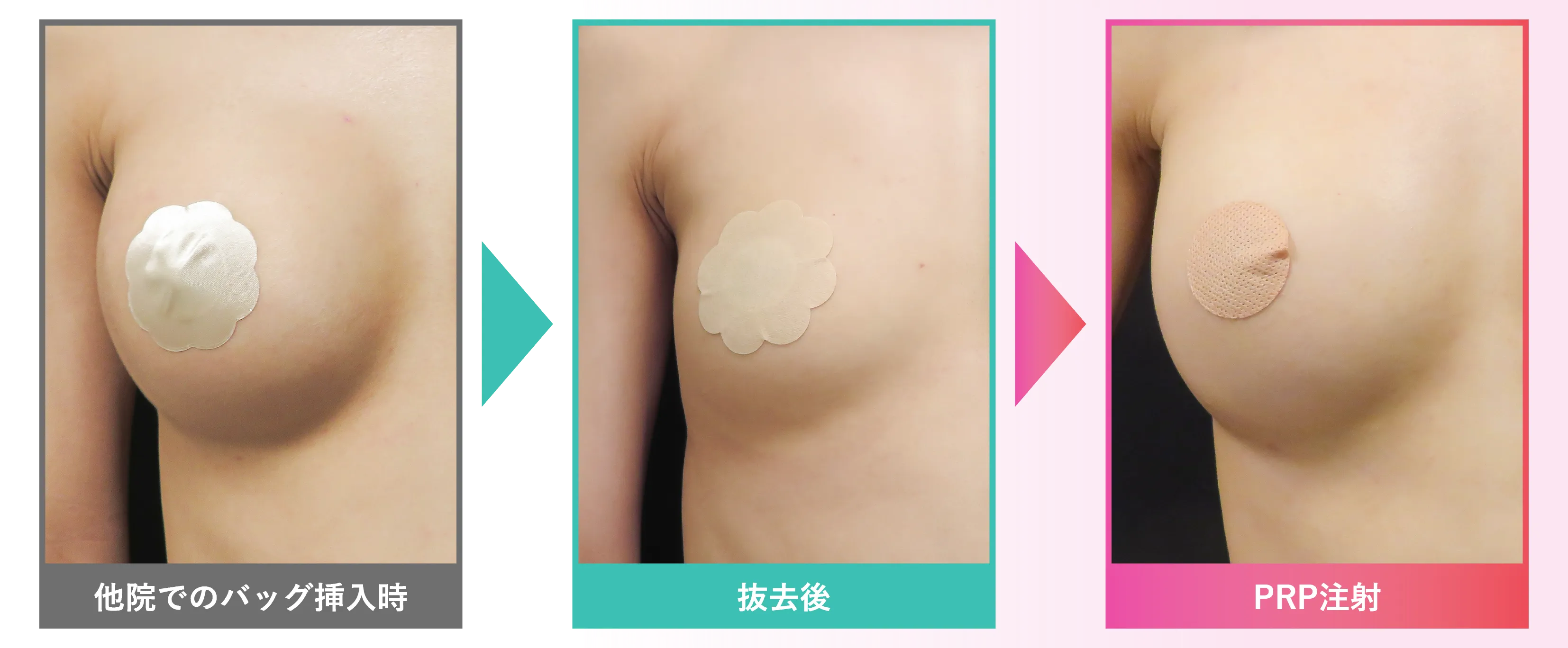 抜去後のPRP注入 安心