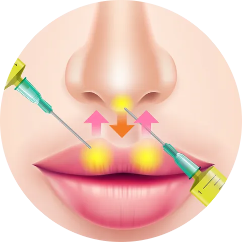 PRP注射注入部位