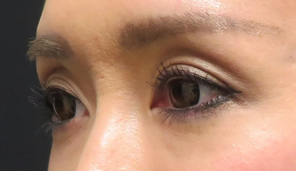 まぶたがくぼみ、深いシワ（線）が現れている状態