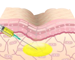 クマの原因となる凹みやくすみにPRPを注入