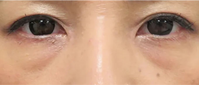 目の下にメラニン色素の沈着や角質が厚くなっている状態。