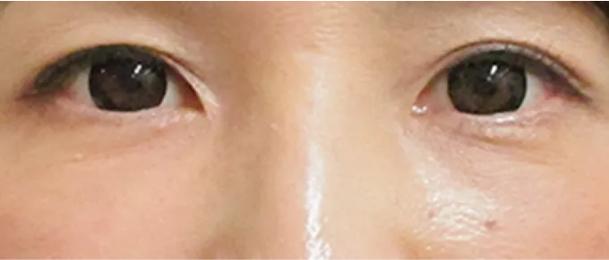 美肌効果により色素沈着が改善し、透明感のある肌質になる。