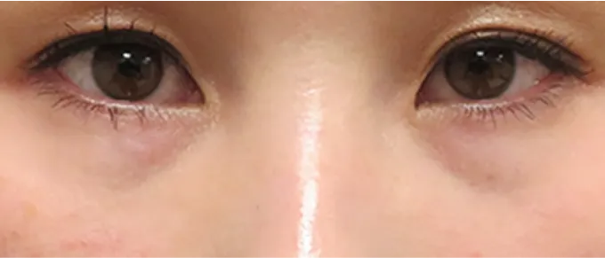 目の下の皮膚が薄く透けて血液が見えている状態。