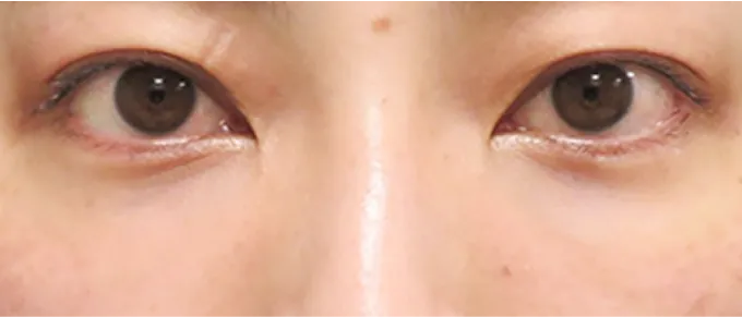 影の原因となる凹みを、脱脂術と肌再生効果の相乗効果でクマを改善。