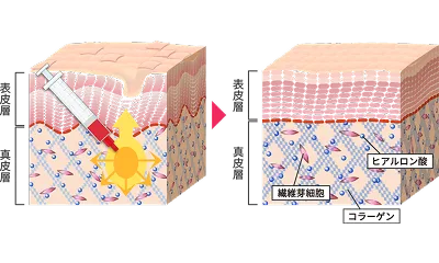 持続効果は5年以上！