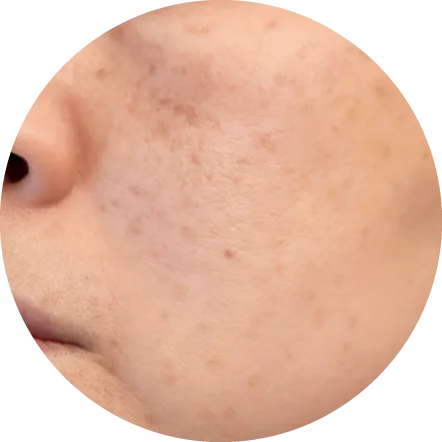 シワ・シミ・くすみ・ニキビ跡を改善したい