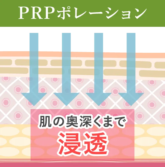 PRPポレーション