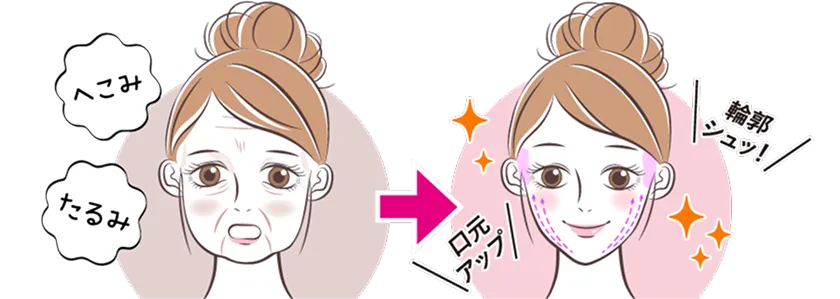 複合治療で深い凹みや脂肪によるたるみも同時に改善