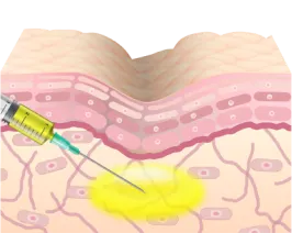凹みやくすみの部分にPRPを注入