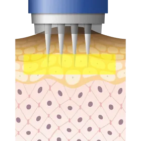 水光注射で黒ずみ部分にPRPを注入