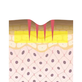 注射孔にミラノピールを浸透