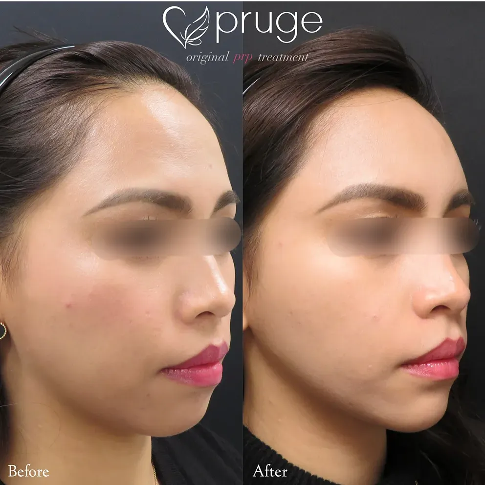 PRP注射：施術部位 額・こめかみ、ほうれい線 / pスリム注射：施術部位 ほうれい線上〜フェイスライン