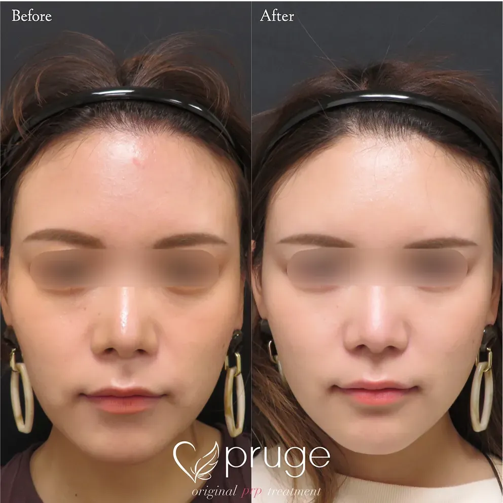PRP注射：施術部位 額・こめかみ／目の下 / pスリム注射：施術部位 ほうれい線上〜口元