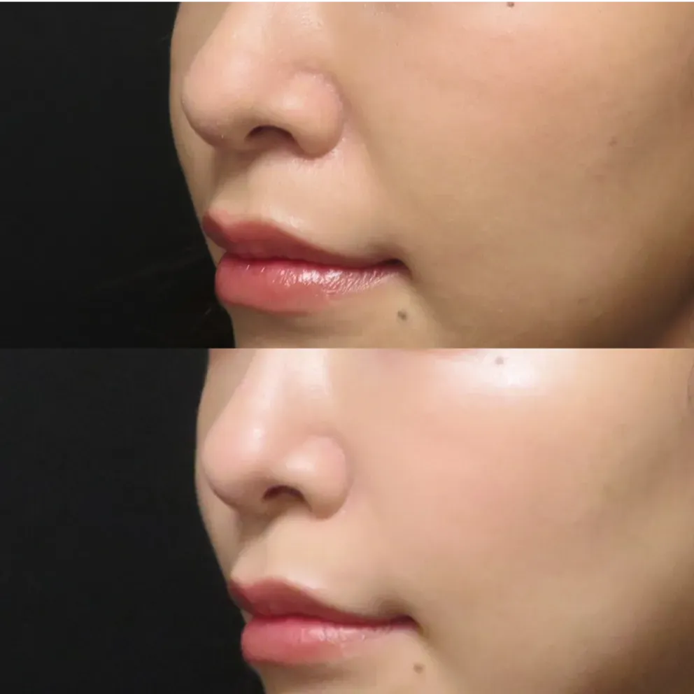 PRP注射：施術部位 ほうれい線 / pスリム注射：施術部位 ほうれい線上