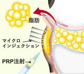 「下まぶたの裏側から脂肪を取り、同時にPRP注射とMIを行う」のイラスト