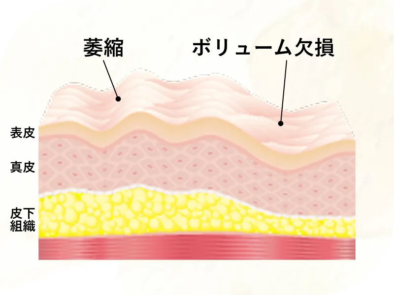 傷ついた組織の再構築