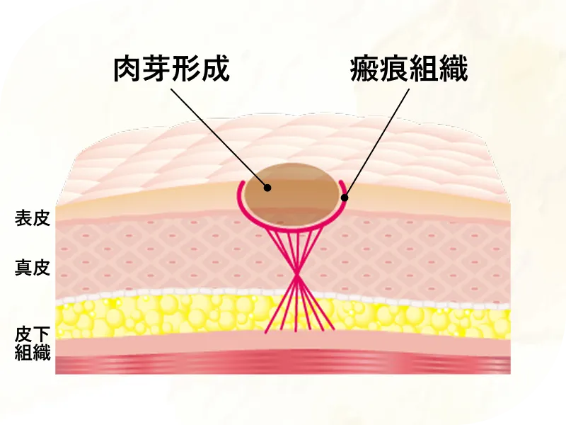 瘢痕や陥凹にもアプローチ