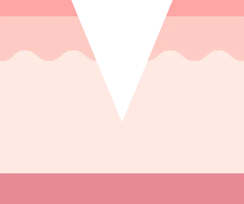 アイスピック型