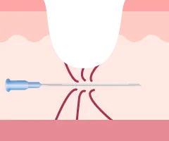 特殊な針で線維を切断