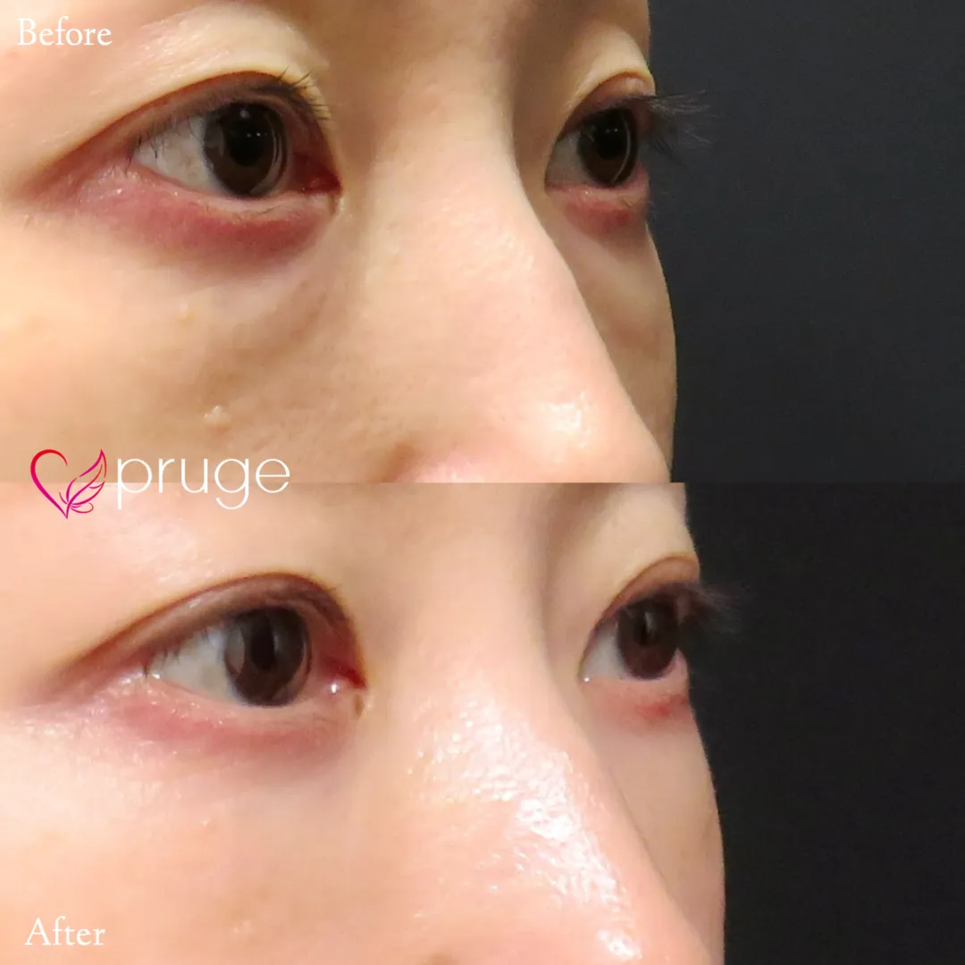 PRP-MI脱脂術（目の下）