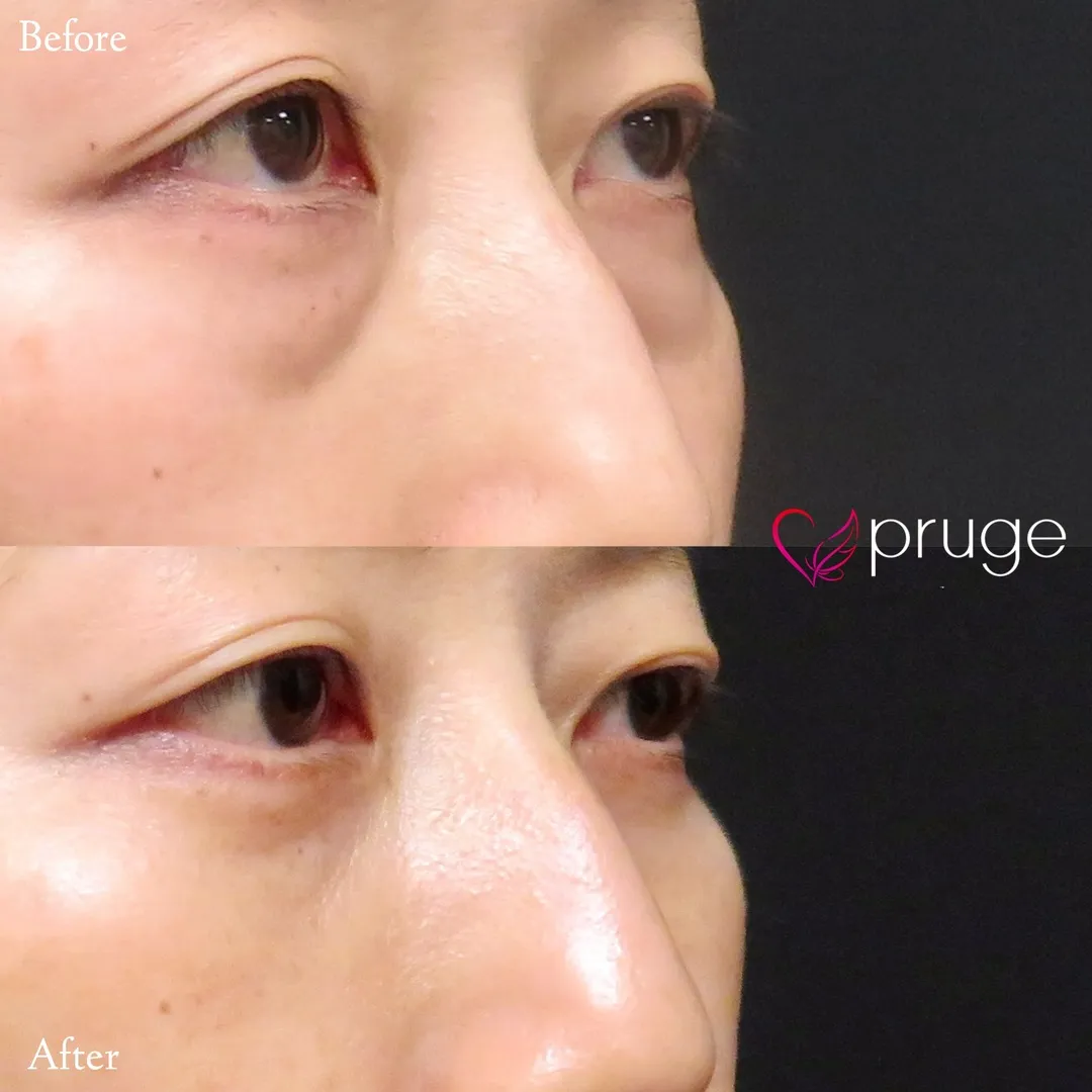 PRP-MI脱脂術（目の下）