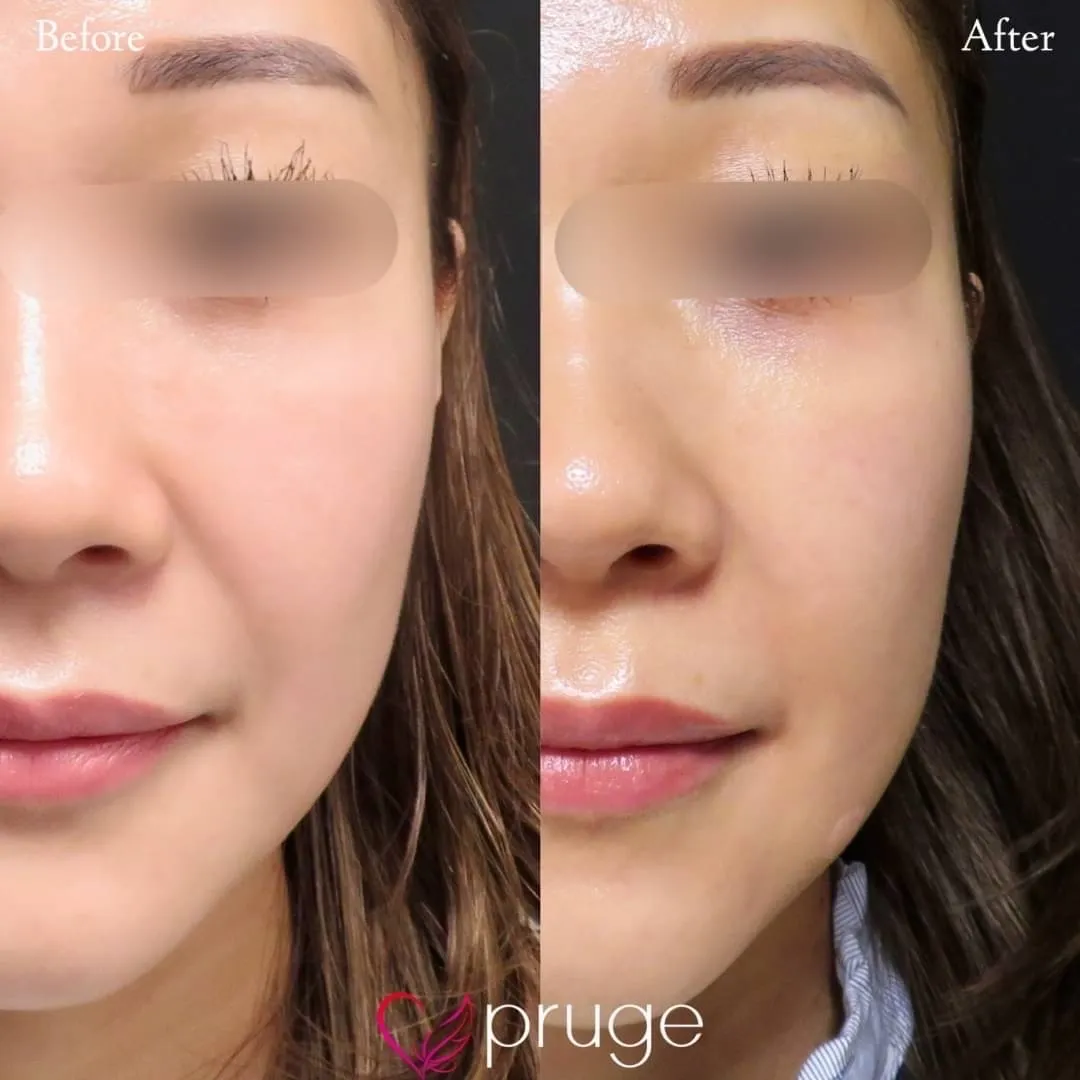 PRP注射（ほうれい線）