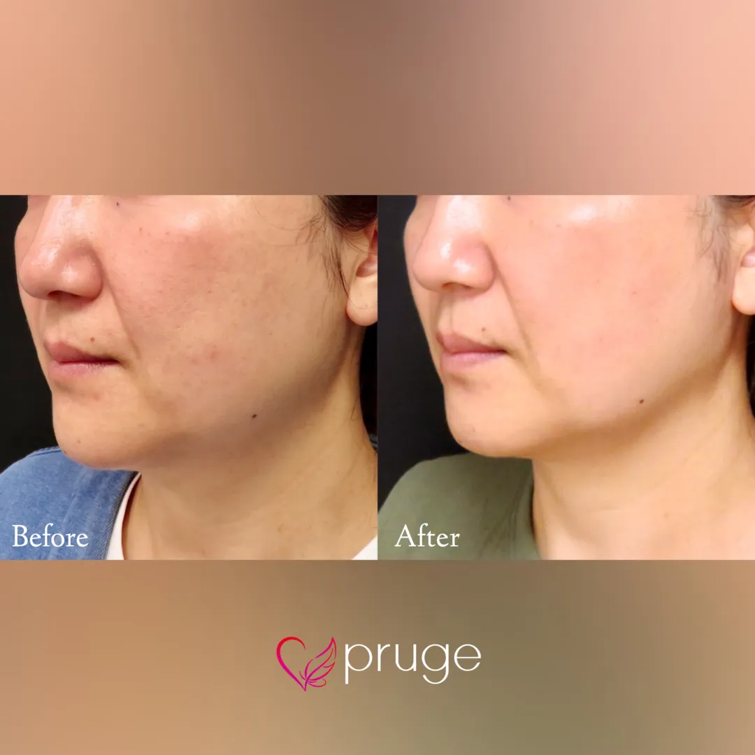 pスリム注射（フェイスライン・あご下）