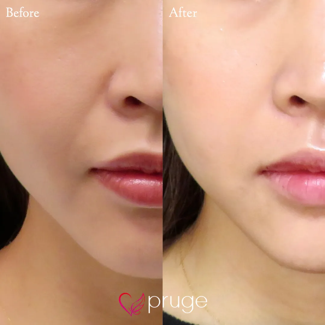 PRP注射（ほうれい線）