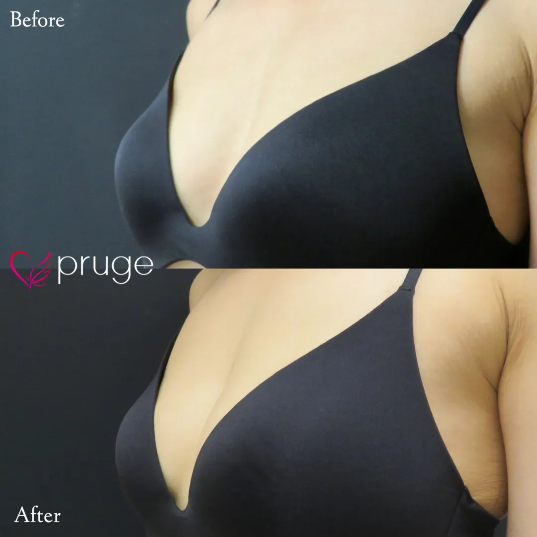 PRP注射（お胸）