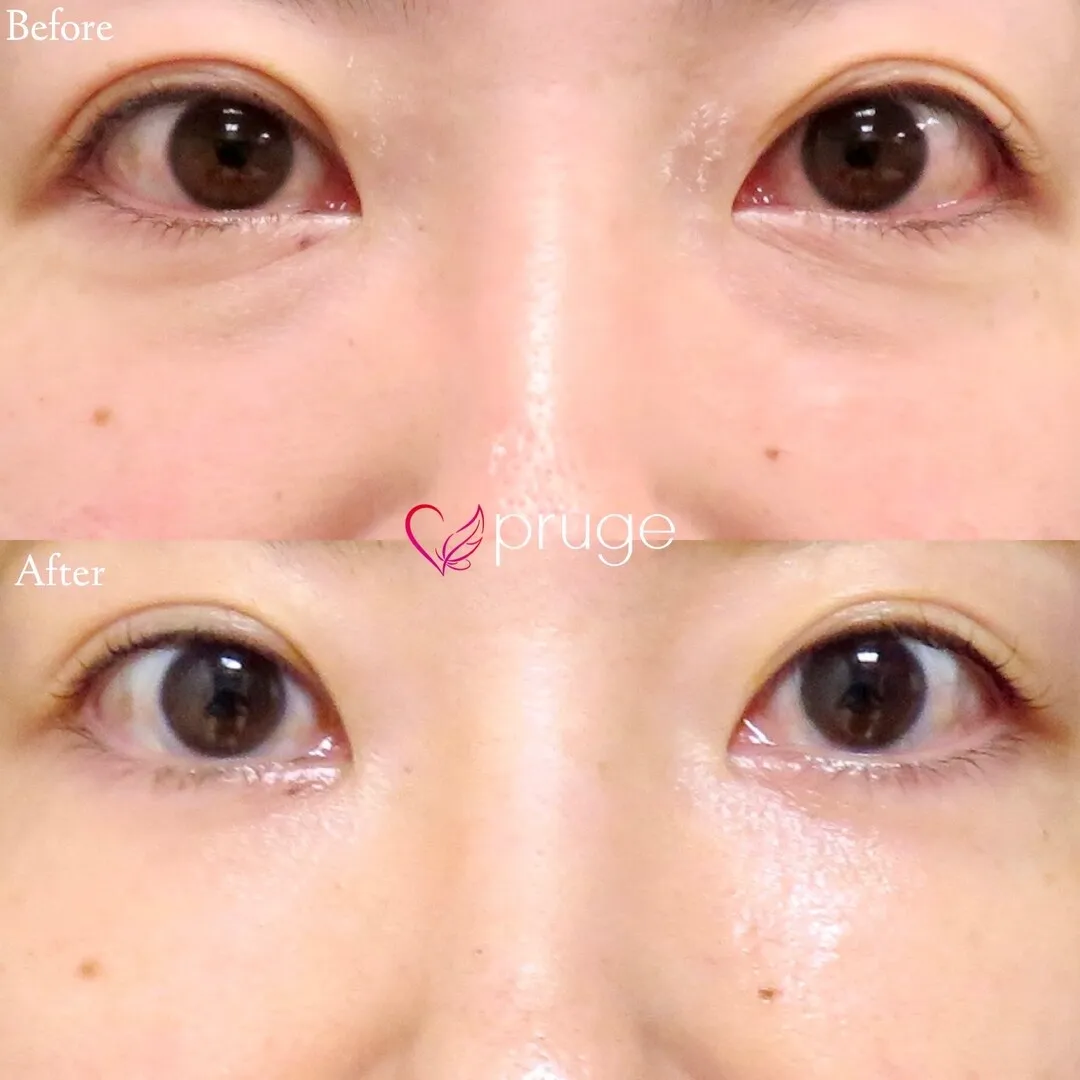 PRP注射（目の下）