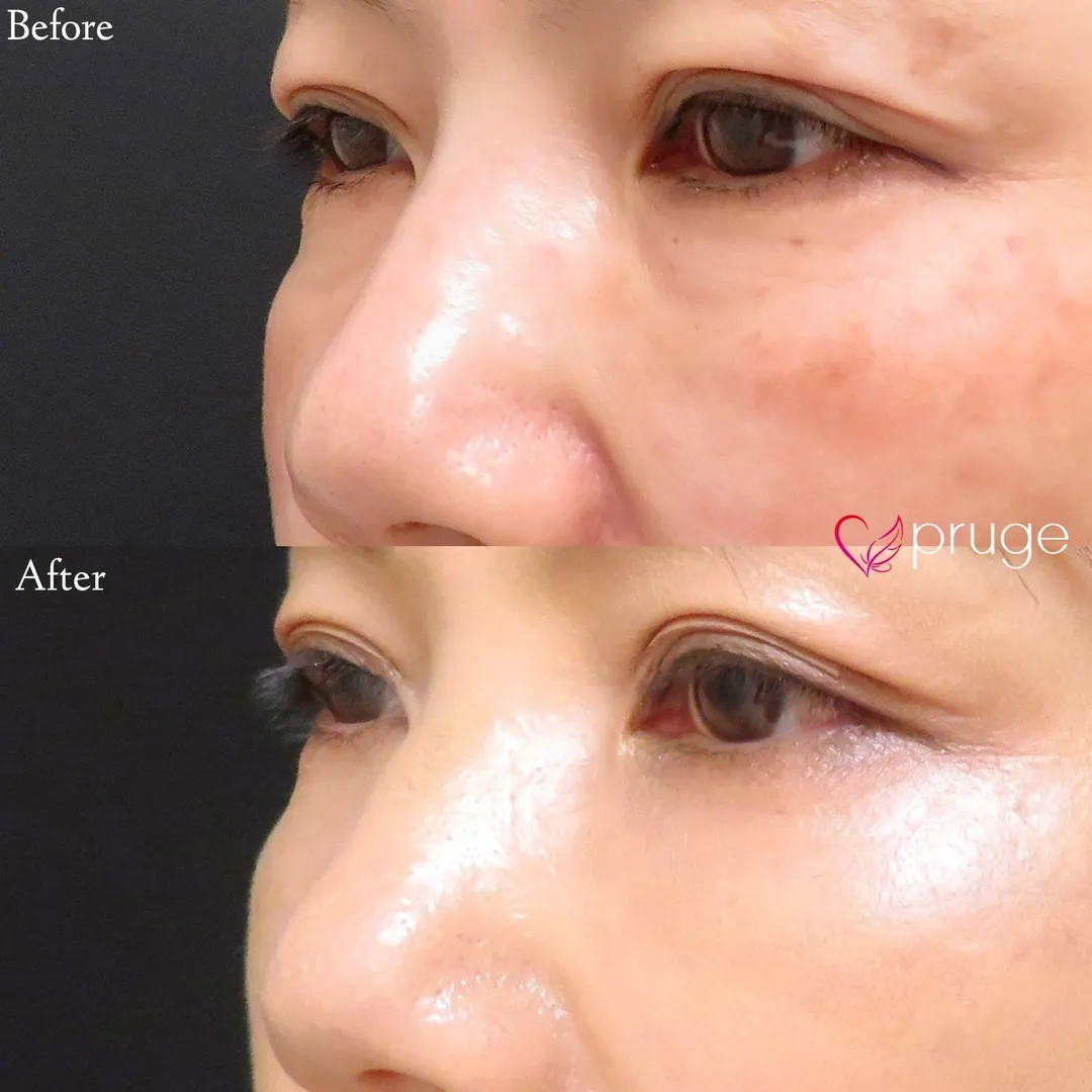 PRP-MI脱脂術（目の下）