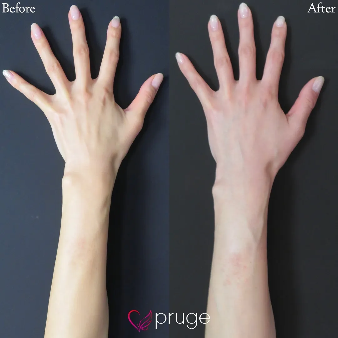 PRP注射（手の甲）