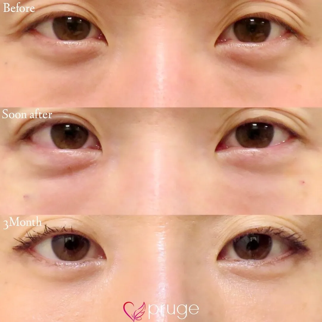 PRP-MI脱脂術（目の下）