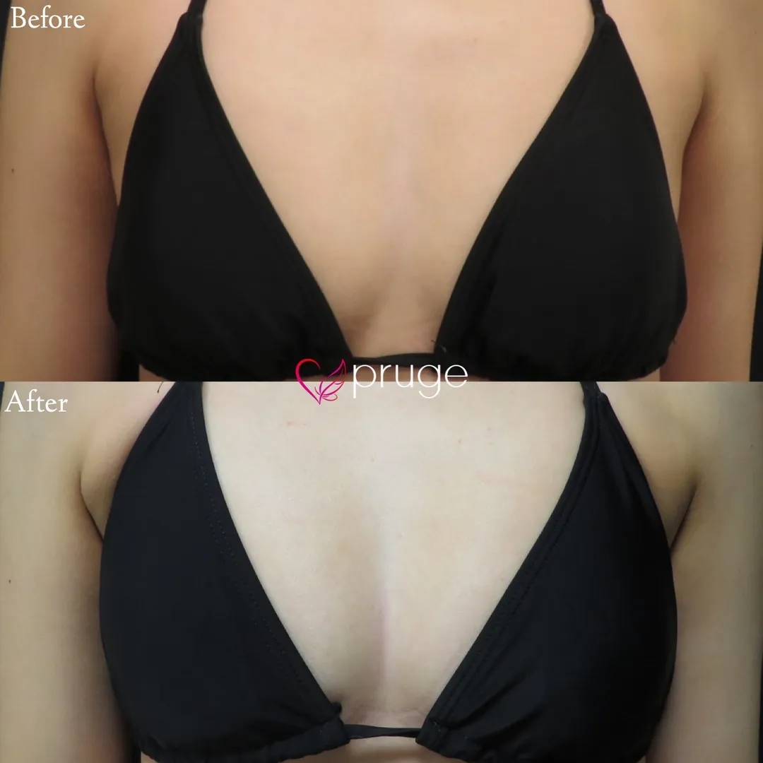 PRP注射（お胸）