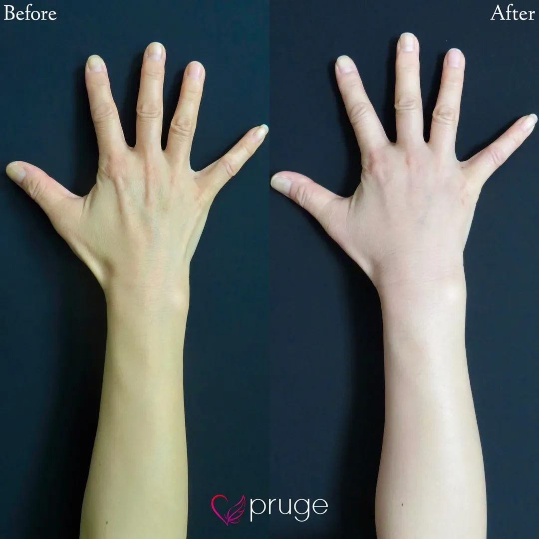 PRP注射（手の甲）