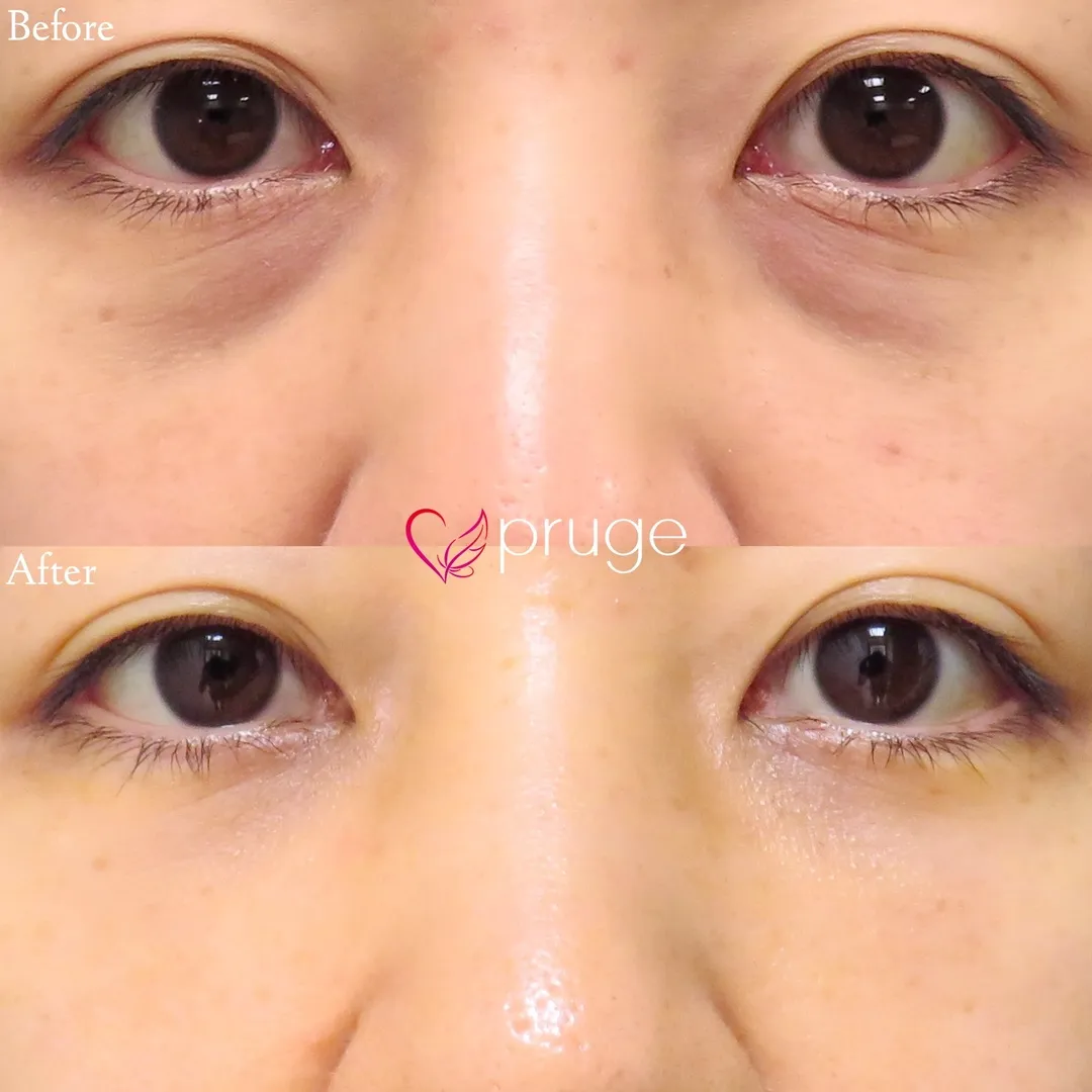 PRP-MI脱脂術（目の下）