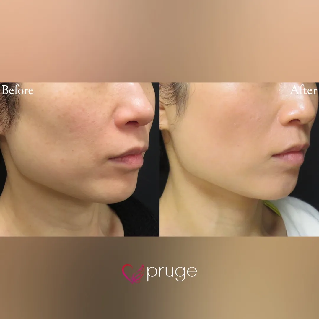 PRPコラーゲンリフト（ホホ・フェイスライン）80本