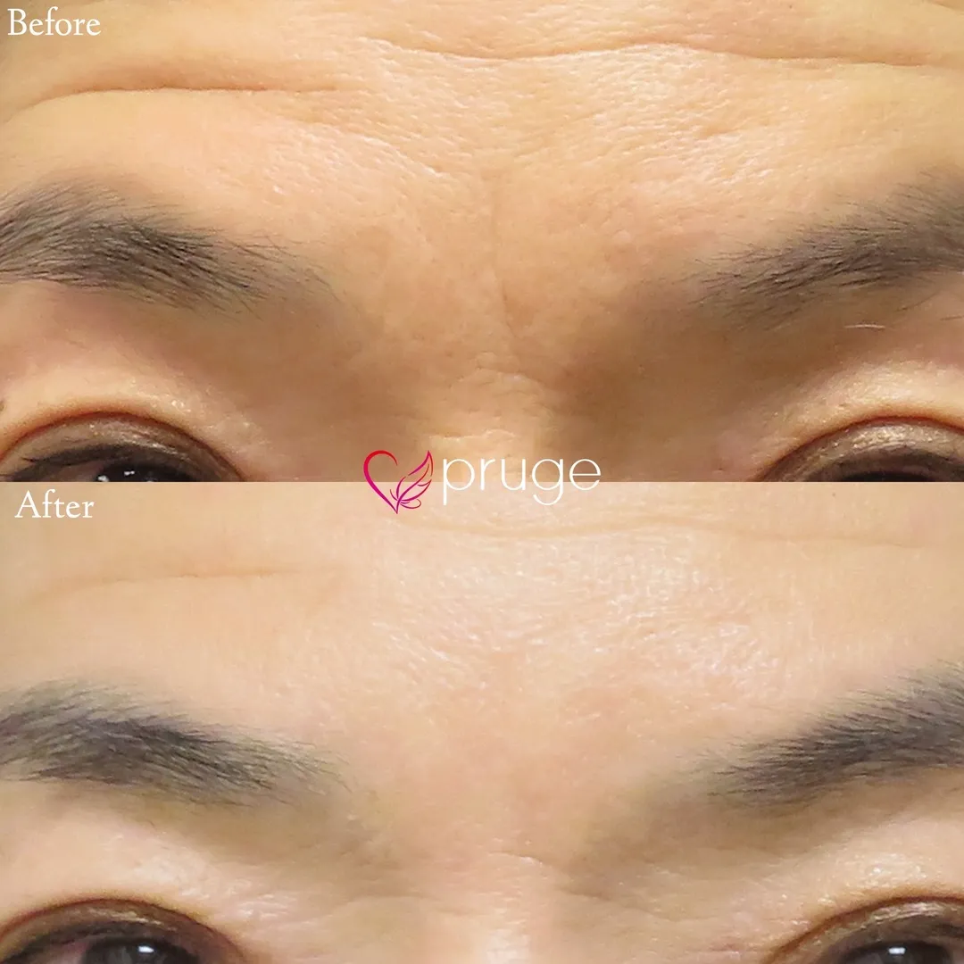 PRP注射（眉間）