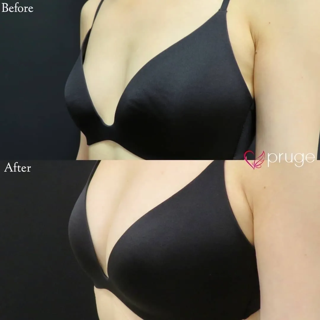 PRP注射（お胸）