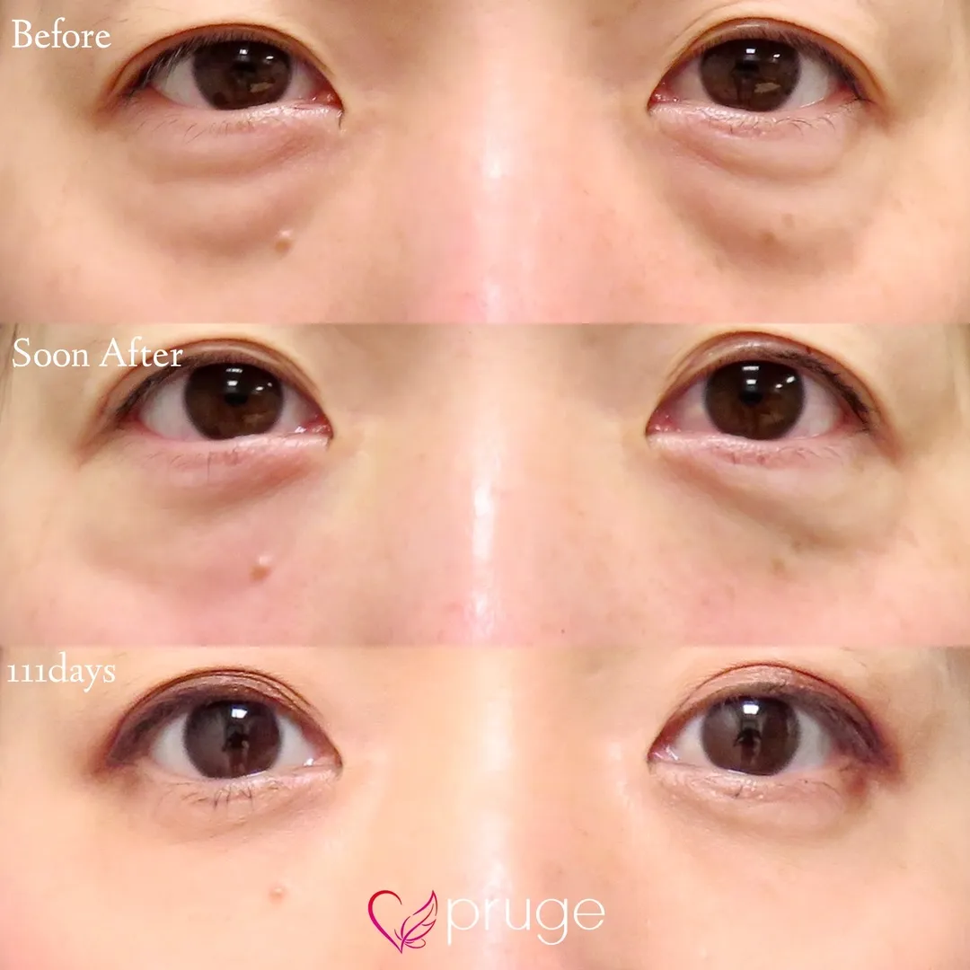 PRP-MI脱脂術（目の下）