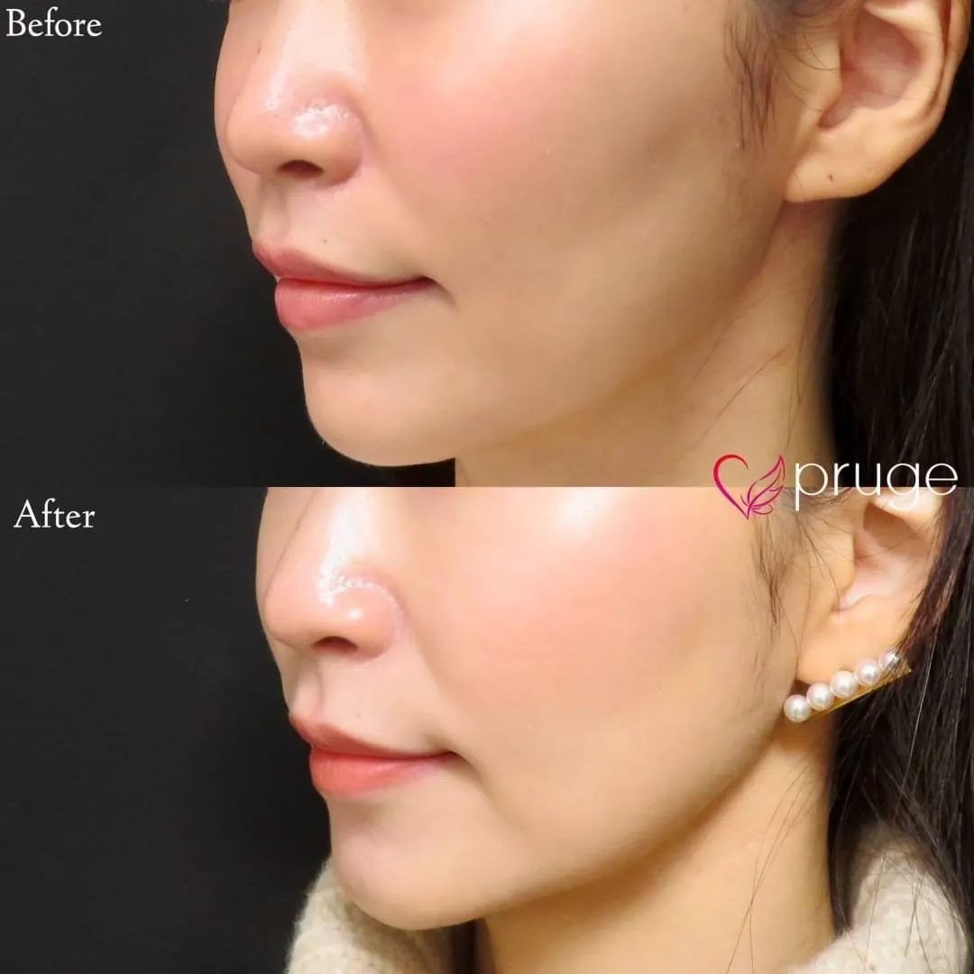 PRP注射（ホホ）