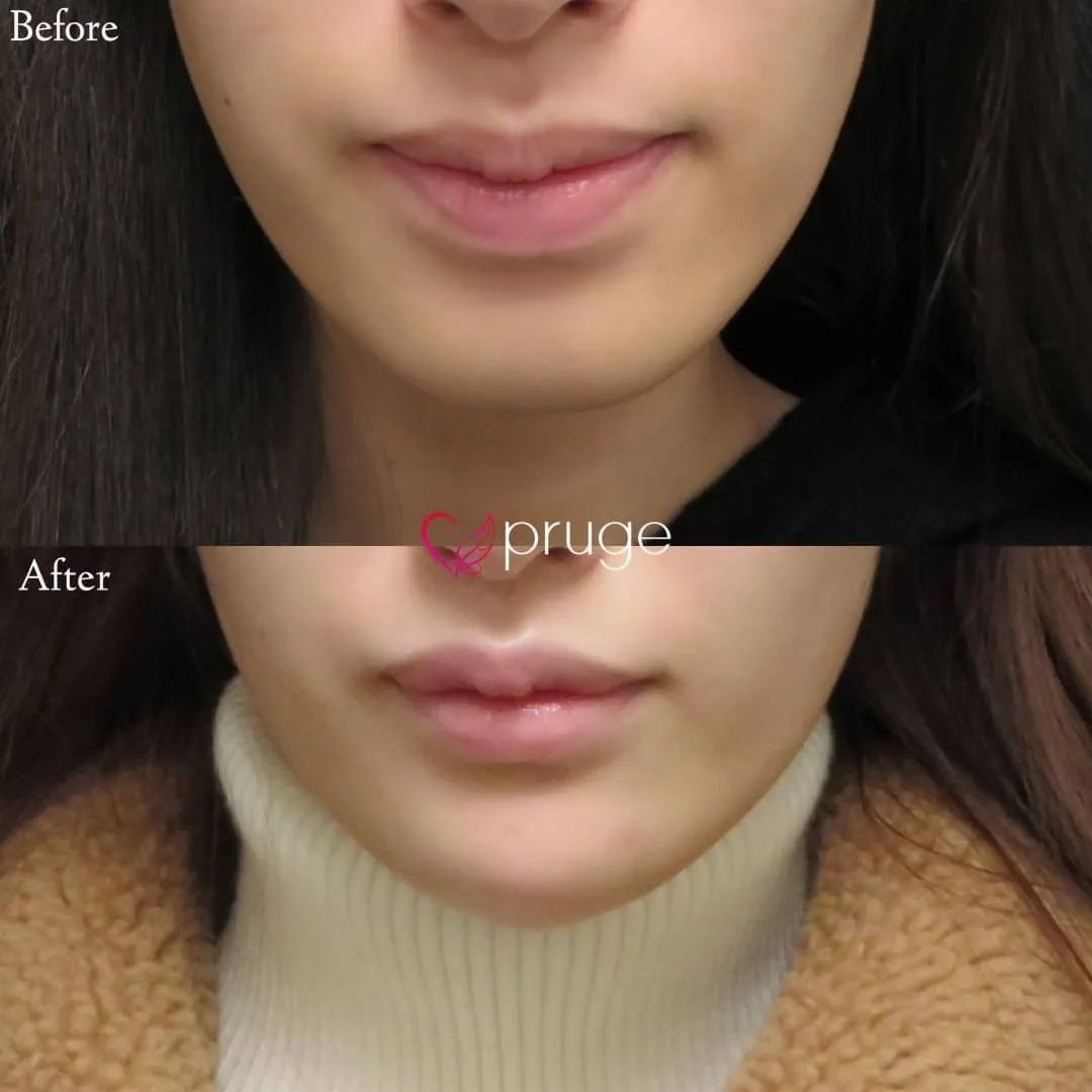 PRP注射（あご）