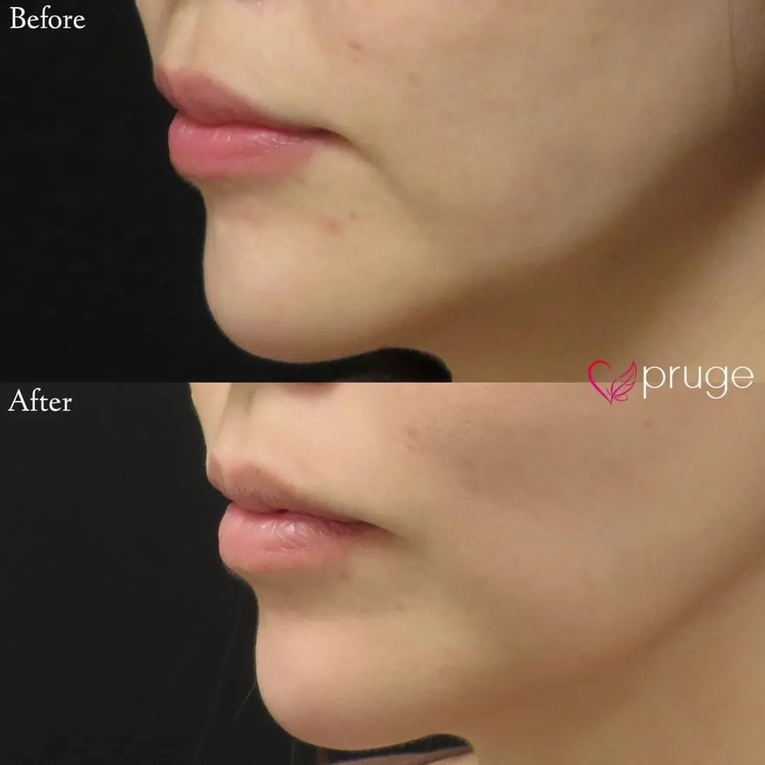 PRP注射（マリオネットライン）